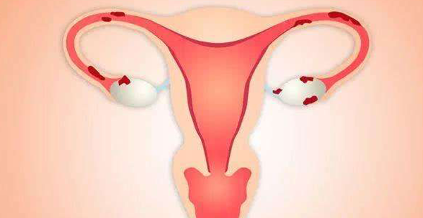 试管冷知识：输卵管积水及时治，提升怀孕成功更容易！