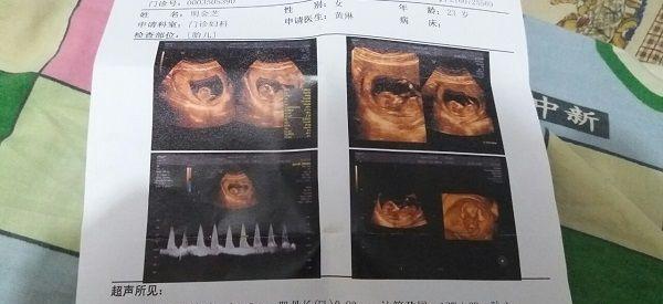 孕23周如何根据彩超3数据计算男女宝宝双顶径？