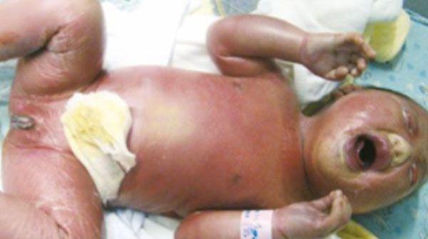 火棉胶婴儿的生存率并不低，防范得当时和正常人寿命无异