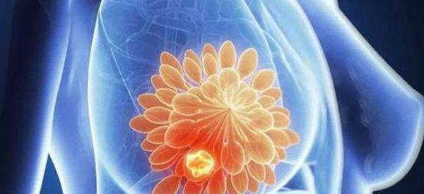 一年两次乳腺钼靶检查会引起癌变吗？