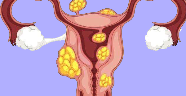 1/4的不孕均与子宫肌瘤有关，若月经量多就得小心了！