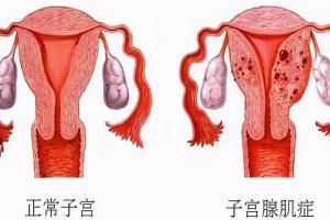 腺肌症不治会有什么后果，不仅影响怀孕还可能子宫难保