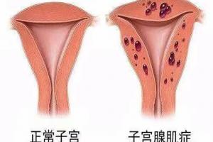 腺肌症做试管是先取卵还是打针？权威答案来啦