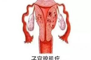 试管科普：腺肌症子宫多大可以移植胚胎？看完你心中就有数了