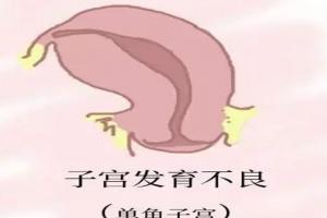 先天性单角子宫能自然受孕吗？医生给出了具体答案