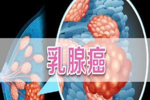 盘点乳腺癌的15个征兆，早发现还有救