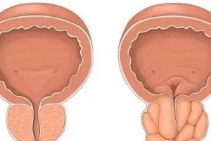 前列腺增生多吃八种食物，让你远离疾病困扰