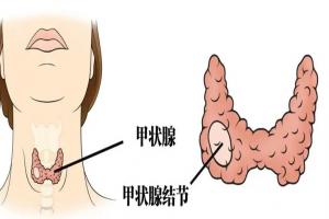 女性甲状腺的6个早期症状，占一样也别硬扛