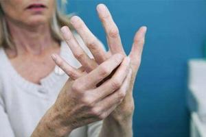 女性类风湿治疗的6个最佳方法，助你摆脱止疼药