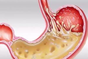 胃酸怎么缓解最快方法？6招助你减轻痛苦
