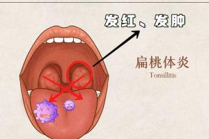 扁桃体发炎不能吃什么水果？这七种水果千万不能碰