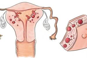 子宫腺肌症最忌讳什么？答案全在这里