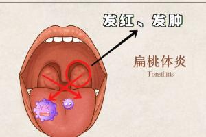 扁桃体发炎快好的4个征兆，恭喜你很快就可以继续活跃了