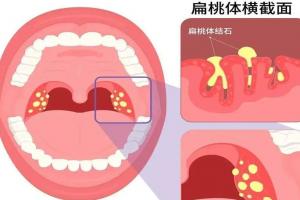 扁桃体结石是什么原因引起的？多半是这六个原因在作怪