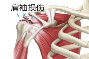 健康科普：肩袖损伤的四个表现，早知早受益
