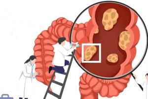 健康科普：直肠癌早期的5大症状，越早发现危险越小