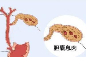 胆囊息肉吃什么食物好？这五类食物是不错之选