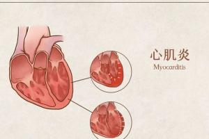 怎么判断自己得了心肌炎？身体出现这些征兆时就要重视了