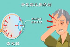 青光眼不能吃食物列表，这6类食物最好不要沾