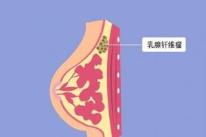 乳房纤维瘤的三个明显特征，稍不注意可能会更严重