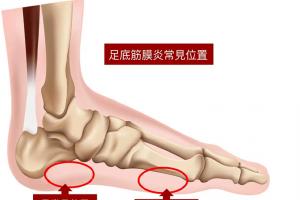 足底筋膜炎4个痛点介绍，分享3种快速止疼方法