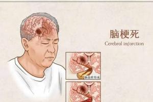 轻度脑梗怎么治疗？谨遵医嘱对症下药