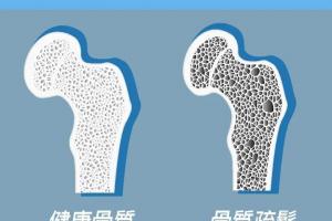 三种食物吃走骨质疏松，补钙强骨质腿脚更灵活