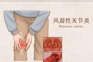 风湿是因为什么原因引起的？不外乎这6个“罪魁祸首”