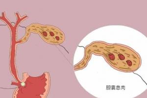 女人长胆囊息肉的原因，或许是这6大因素所致