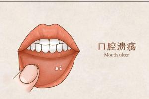 哺乳期口腔溃疡小妙招，教你这4招解决口腔问题