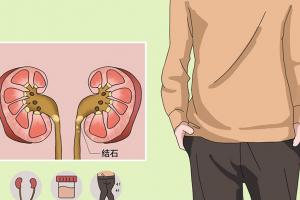 尿结石不能吃什么食物？常吃这5类食物可能让病情更严重