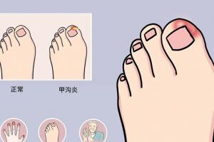 甲沟炎自愈的十大方法，教你不拔指甲，也能轻松解决