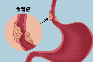 科普食道肿瘤扩散的前兆，你需要时刻留意