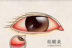 过敏性结膜炎自愈的最佳方法，4大秘方最为有效