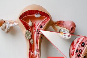 子宫腺肌症试管可以移植2个囊胚吗？3大风险值得重点关注