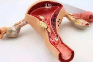 一文解析：子宫肌腺症能否做试管吗？试管成功率高吗？