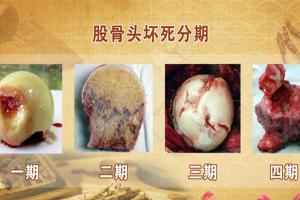 股骨头坏死早期症状，很多人错以为是是“关节炎”