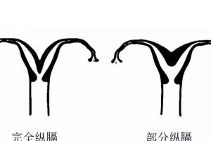不完全子宫纵隔能做泰国试管吗？专家建议：最好治疗后再进周