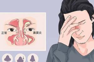 鼻炎应该注意些什么？日常这四点最好谨记