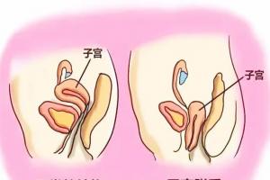 怎么治疗子宫脱垂最快？5种常见方式应按需选择