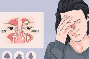 女性鼻窦炎的最明显症状，出现这几点就要注意了