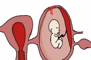 残角子宫可以不切除直接做试管不？生殖专家马上为你揭晓答案