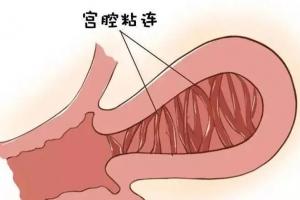 速看：宫腔粘连严重，试管3次不成功原因分析