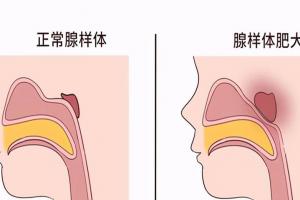腺样体肥大的孩子必须做手术吗？不一定，遵医嘱治疗即可
