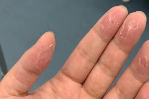 手指脱皮快速恢复方法，5个改善方法拿走不谢