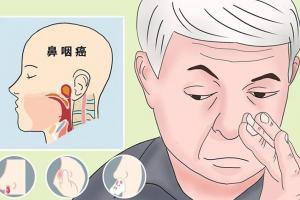 鼻咽癌早期症状表现，这6种症状，可能是鼻咽癌信号