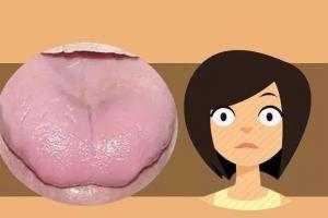 舌头上有裂纹是什么原因？6种原因可导致裂纹舌