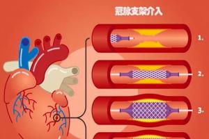 心脏支架后最怕三件事，如果你有，必须马上改正