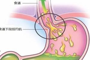 胆汁反流自愈四个动作分享，赶紧截图收藏