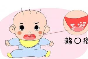 鹅口疮自愈的最好办法，4个治疗方式供选择